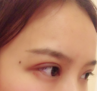 長(zhǎng)春麥西美嘉整形醫(yī)生王圣博做雙眼皮手術(shù)效果怎么樣？附雙眼皮案例