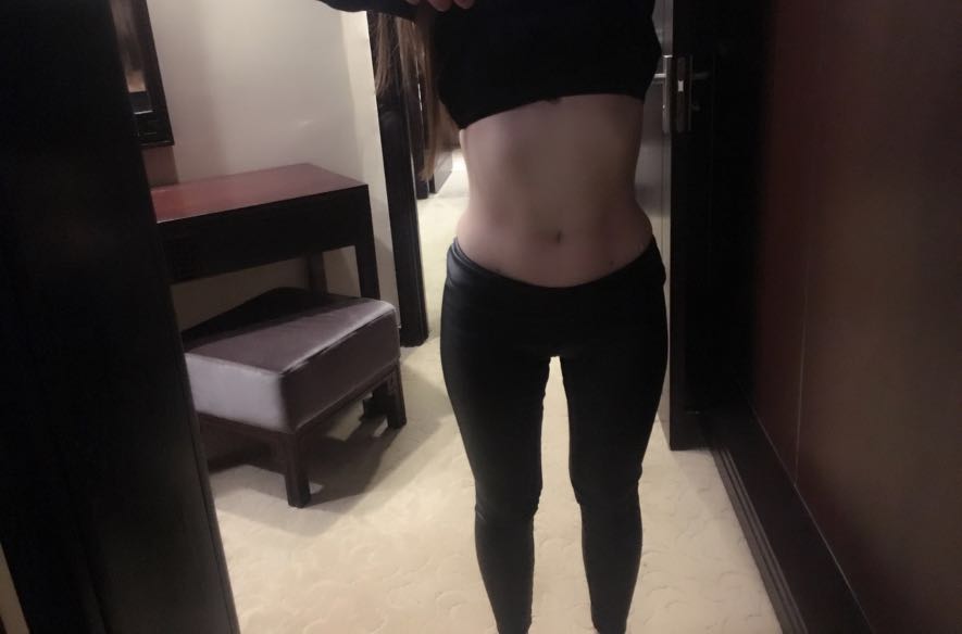 肇慶華美整形醫(yī)院陳巍醫(yī)生做腰腹吸脂效果怎么樣？附腰腹吸脂案例