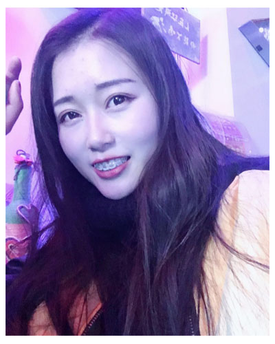 義烏傅氏口腔醫(yī)生朱雨晴做牙齒隱形矯正效果怎么樣？附牙齒隱形矯正案例