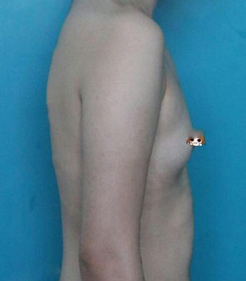 武漢華美整形醫(yī)院趙曉兵醫(yī)生做自體脂肪隆胸怎么樣？附自體脂肪隆胸案例