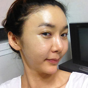 周口華美整形醫(yī)院翟紅光醫(yī)生做面部除皺效果怎么樣？附案例效果對比圖