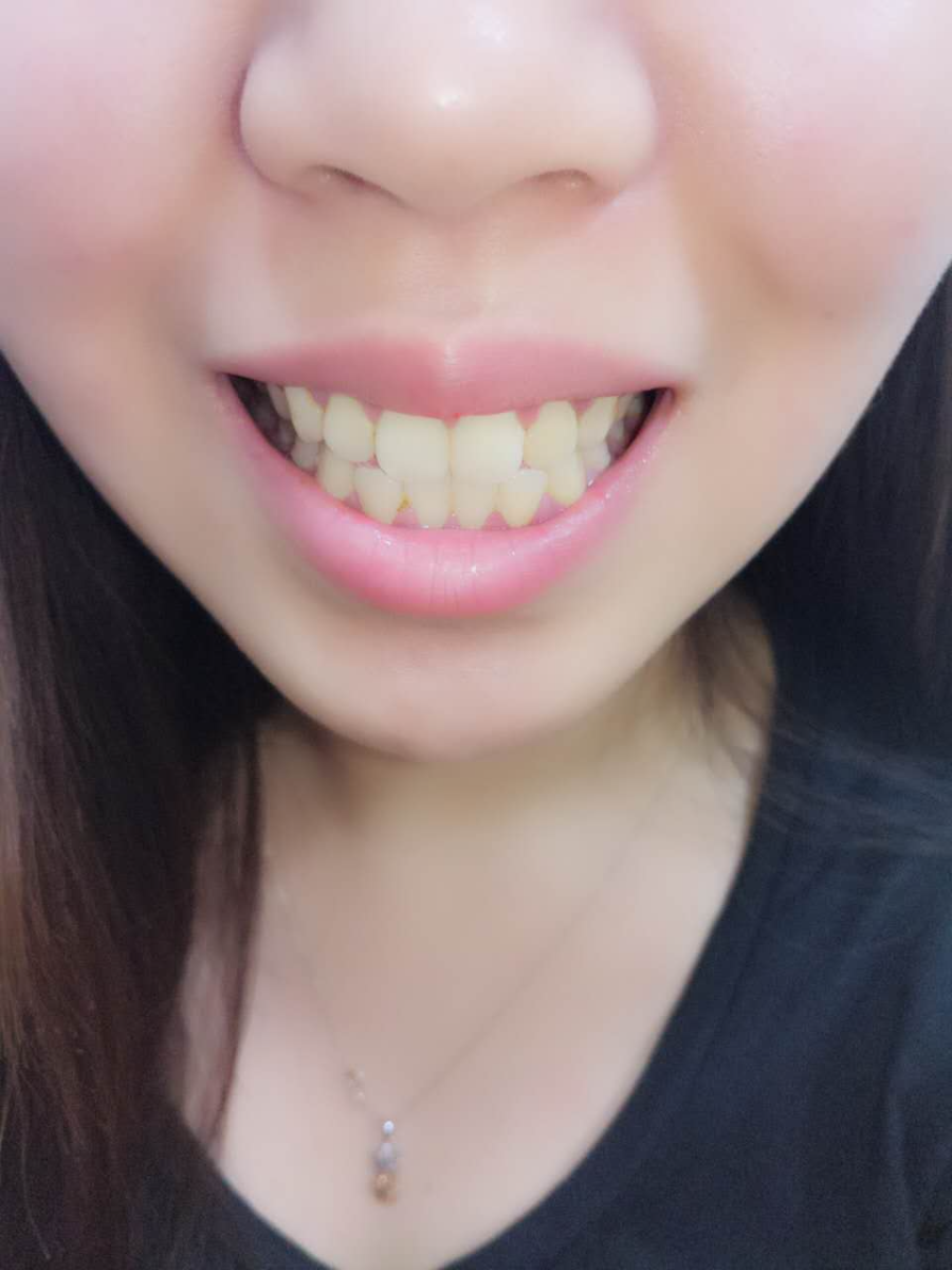 杭州國(guó)雅口腔醫(yī)院張虹醫(yī)生做冷光美白效果怎么樣？附冷光美白案例效果對(duì)比圖