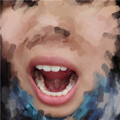 重慶華西牙科醫(yī)院童冠雄超聲波洗牙怎么樣？附超聲波洗牙案例對(duì)比圖