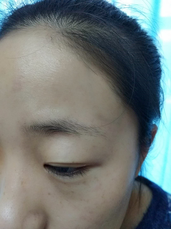 長沙愛思特醫(yī)療美容醫(yī)院做半永久紋眉怎么樣？附彭子娟醫(yī)生案例效果圖