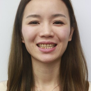 安慶渡江口腔醫(yī)院張良斌醫(yī)生牙齒貼面怎么樣？附牙齒貼面效果圖