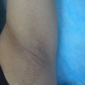 廈門張銘整醫(yī)療整形醫(yī)生張小玲做激光脫腋毛怎么樣？附激光脫腋毛效果對比圖