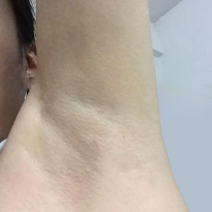 廈門張銘整醫(yī)療整形醫(yī)生張小玲做激光脫腋毛怎么樣？附激光脫腋毛效果對比圖