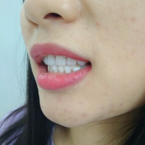 洛陽(yáng)友好口腔醫(yī)院醫(yī)生李新然做牙貼面怎么樣？附案例效果圖