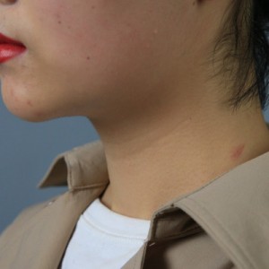 上海名媛醫(yī)療整形醫(yī)生閆嬌君做嗨體去頸紋效果怎么樣？附案例效果圖