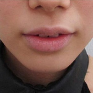 蚌埠韓美美萊整形醫(yī)院醫(yī)生張濤做玻尿酸墊下巴怎么樣？來看案例效果圖