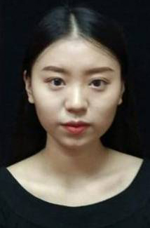 長沙星雅醫(yī)療美容醫(yī)院醫(yī)生陳煥武做埋線提升怎么樣？