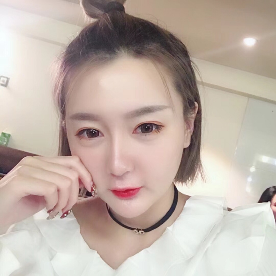 杭州格萊美整形美容醫(yī)院醫(yī)生張霞飛做自體脂肪全臉填充效果怎么樣？