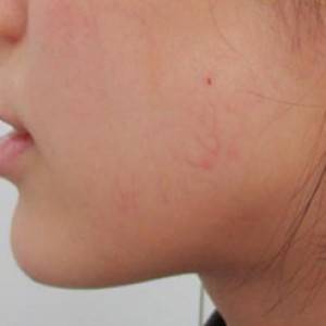 蚌埠韓美美萊整形醫(yī)院醫(yī)生張濤做玻尿酸墊下巴怎么樣？來(lái)看案例效果圖