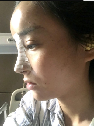武漢米蘭醫(yī)療美容醫(yī)生柳再億做眼綜合+鼻綜合整形怎么樣？附真實案例對比圖