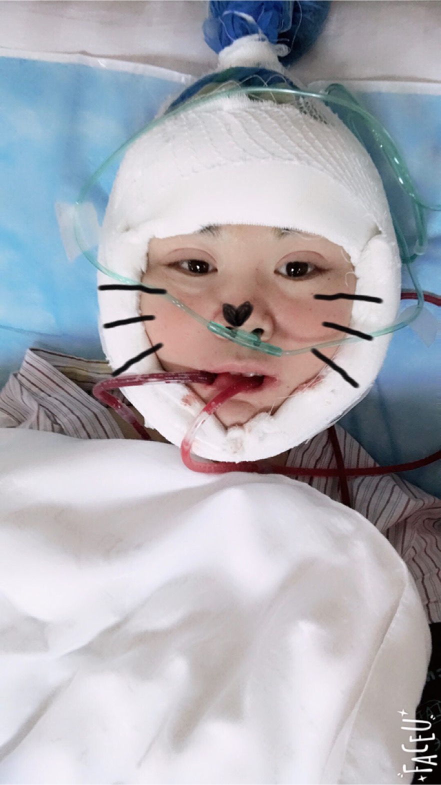 北京彤美美容整形醫(yī)院醫(yī)生楊曉惠做顴骨內(nèi)推+面部吸脂手術(shù)效果怎么樣？附案例