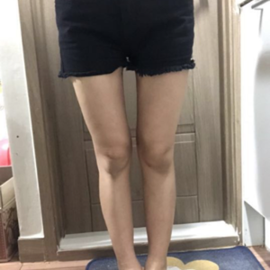 貴陽華美整形美容醫(yī)院醫(yī)生田永華做大腿吸脂效果怎么樣？附大腿吸脂案例前后對比圖