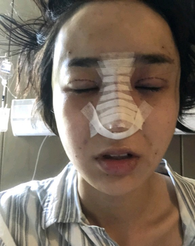 武漢米蘭醫(yī)療美容醫(yī)生柳再億做眼綜合+鼻綜合整形怎么樣？附真實案例對比圖
