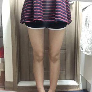 貴陽華美整形美容醫(yī)院醫(yī)生田永華做大腿吸脂效果怎么樣？附大腿吸脂案例前后對比圖