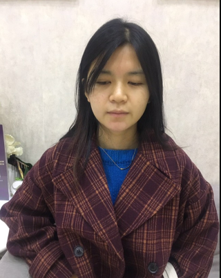 上海時光整形外科醫(yī)院醫(yī)生何晉龍做假體隆胸怎么樣？附案例效果對比圖