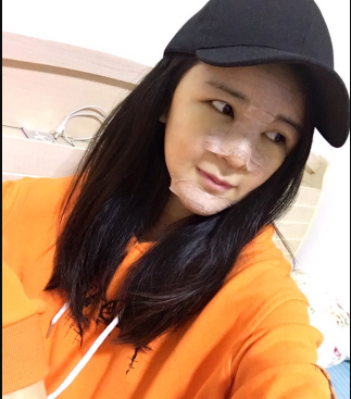 上海時光整形外科醫(yī)院醫(yī)生何晉龍做假體隆胸怎么樣？附案例效果對比圖