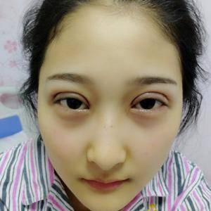 周口垣夢(mèng)醫(yī)療整形醫(yī)生王濤做切開雙眼皮怎么樣？附切開雙眼皮案例效果對(duì)比圖