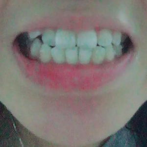 淄博口腔醫(yī)院醫(yī)生牟象鑫做超聲波洗牙怎么樣？附案例效果對比圖