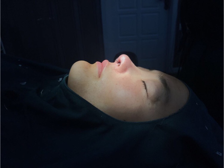 北京集美名媛醫(yī)療整形醫(yī)生陳瀅雯做自體耳軟骨隆鼻怎么樣？附案例效果圖