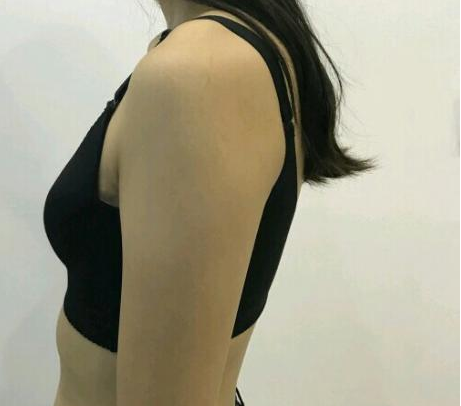 武漢伽美醫(yī)療美容醫(yī)院醫(yī)生朱富初做自體脂肪隆胸怎么樣？看案例