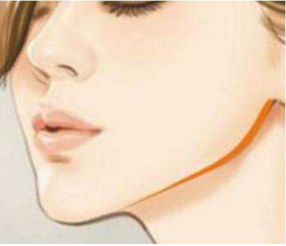 深圳福華中西醫(yī)結合醫(yī)院醫(yī)學美容科下頜角整形