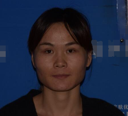 上海時光整形醫(yī)生何晉龍做下頜角磨骨術前術后案例效果對比圖