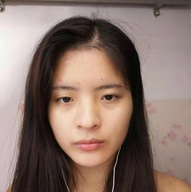 合肥韓美整形醫(yī)院做雙眼皮+開眼角效果怎么樣?附石顯武醫(yī)生真實(shí)案例效果圖