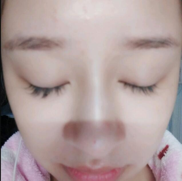 上海時光整形做玻尿酸注射隆鼻效果怎么樣？附陳文慧醫(yī)生真實案例對比圖