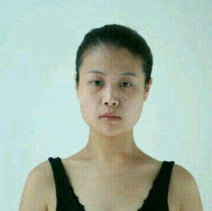 合肥韓美整形醫(yī)院做隆鼻手術(shù)效果怎么樣?附劉冷醫(yī)生隆鼻案例效果圖