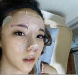 上海時光整形醫(yī)生何晉龍做假體隆鼻效果怎么樣？附案例效果對比圖