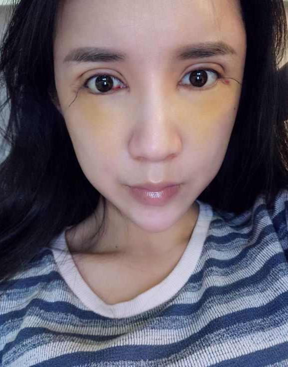 上海時光整形醫(yī)院張晶醫(yī)生做開眼角怎么樣？附真實效果圖