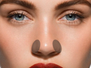 海南華美醫(yī)學美容醫(yī)院鼻翼縮小