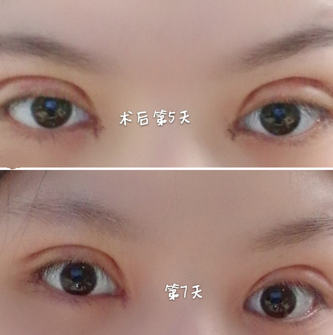 雙眼皮案例效果對比照