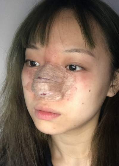 蚌埠韓美美萊整形做手術(shù)縮鼻頭效果怎么樣？附周娜醫(yī)生縮鼻頭案例效果圖