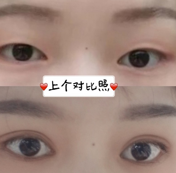 鞍山菲之都醫(yī)療整形醫(yī)院做開眼角+全切雙眼皮效果怎么樣？附藺嬌婷醫(yī)生案例