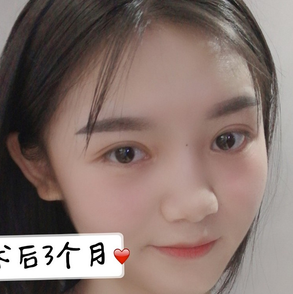 鞍山菲之都醫(yī)療整形醫(yī)院做開眼角+全切雙眼皮效果怎么樣？附藺嬌婷醫(yī)生案例