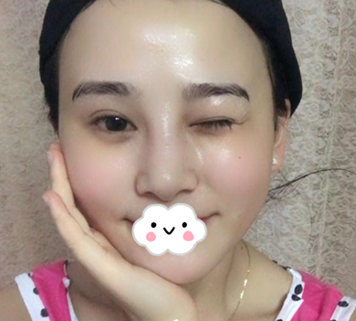 蚌埠韓美美萊整形醫(yī)生歷芳做耳軟骨隆鼻怎么樣？附耳軟骨隆鼻案例對比圖