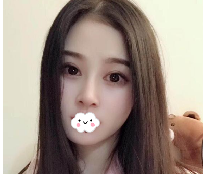 蚌埠韓美美萊整形醫(yī)生歷芳做耳軟骨隆鼻怎么樣？附耳軟骨隆鼻案例對比圖