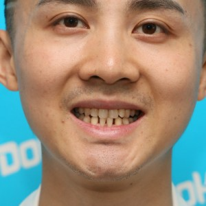 鞍山時代口腔門診部做瓷貼面怎么樣？附孫興國醫(yī)生瓷貼面案例效果圖