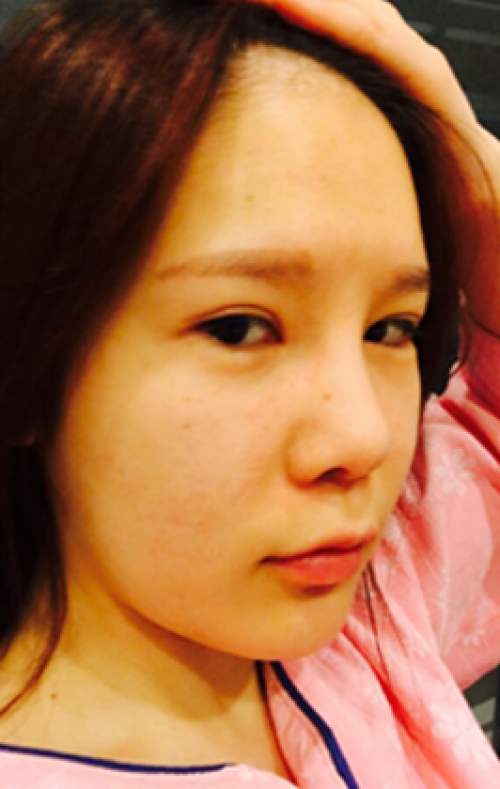 安康希顏醫(yī)療整形醫(yī)生王奇效做面部吸脂怎么樣？附案例效果對比圖