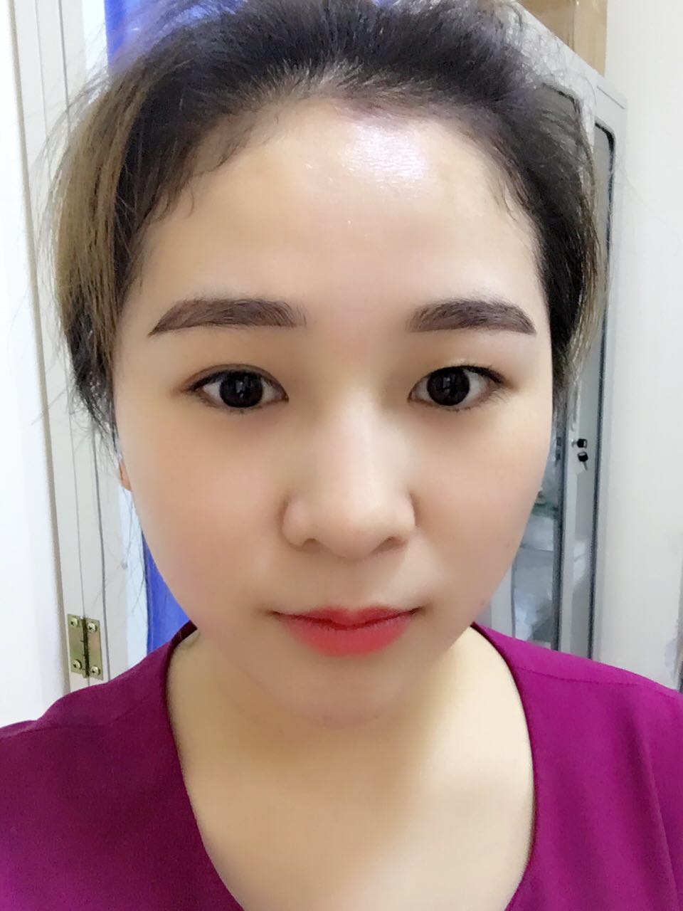 蚌埠韓美美萊整形醫(yī)生鄭捷做開眼角怎么樣？附案例效果圖