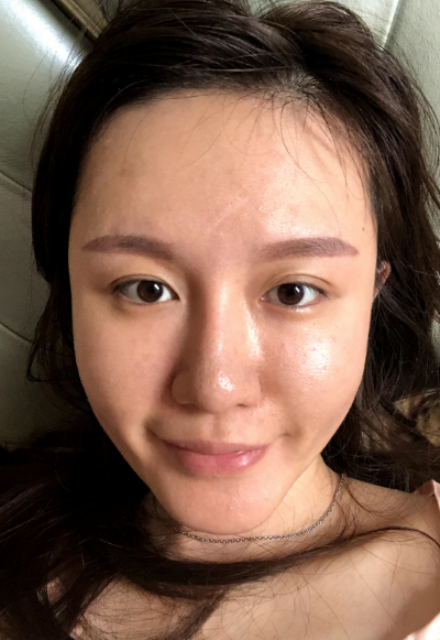 蚌埠韓美美萊整形醫(yī)生張燕做自體脂肪豐面頰效果怎么樣？附案例效果圖