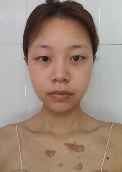 安陽(yáng)市人民醫(yī)院燒傷整形中心做手術(shù)激光祛斑效果怎么樣？附案例效果對(duì)比圖