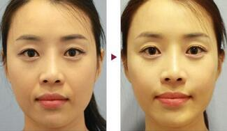 保定安卓貝拉做注射去法令紋怎么樣？附儲君醫(yī)生法令紋案例效果圖