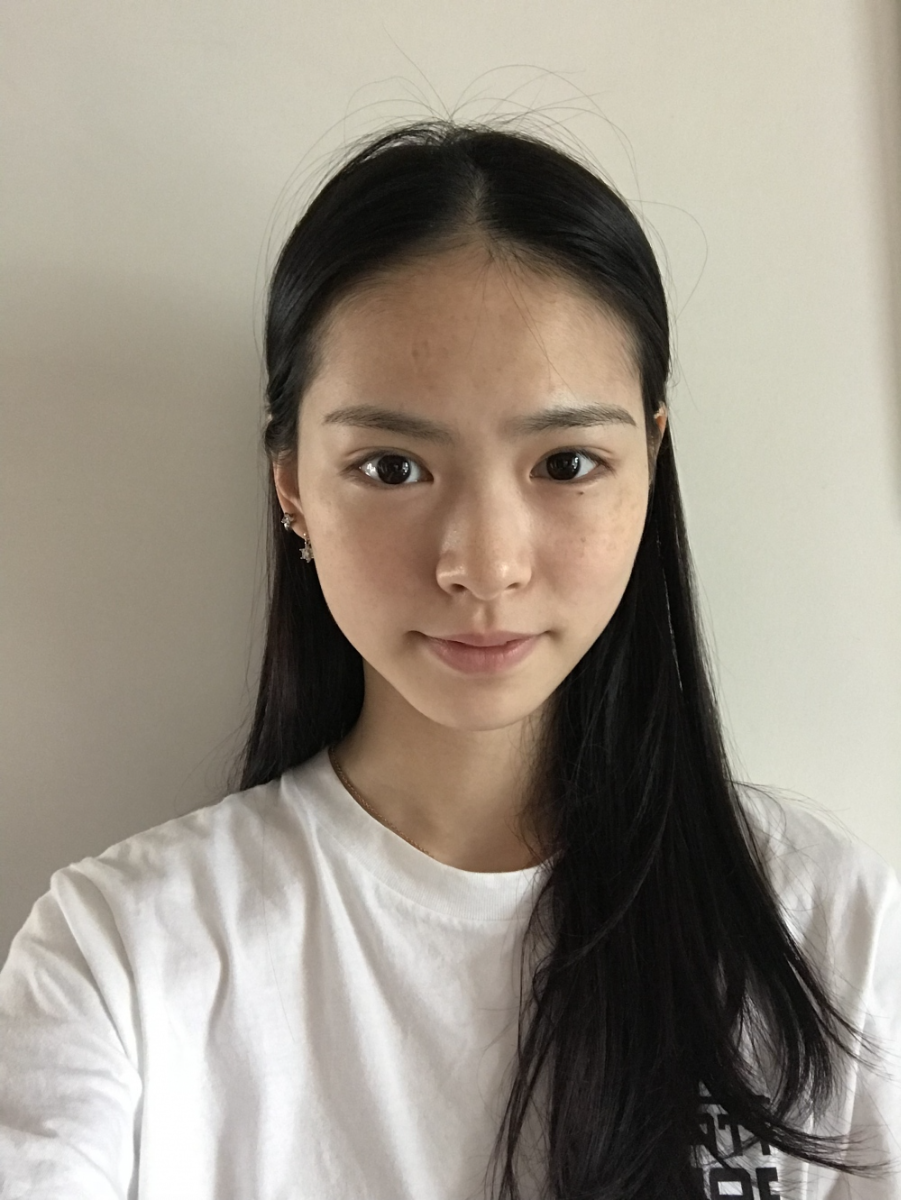 保定市第五醫(yī)院美容整形科做激光祛斑怎么樣？附單敬依醫(yī)生案例效果圖