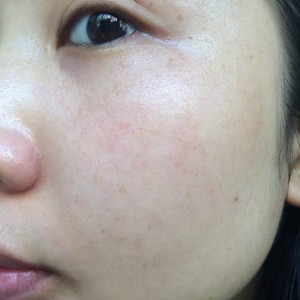 寶雞皮膚病醫(yī)院文東亮醫(yī)生做臉部祛斑效果怎么樣？附臉部祛斑案例